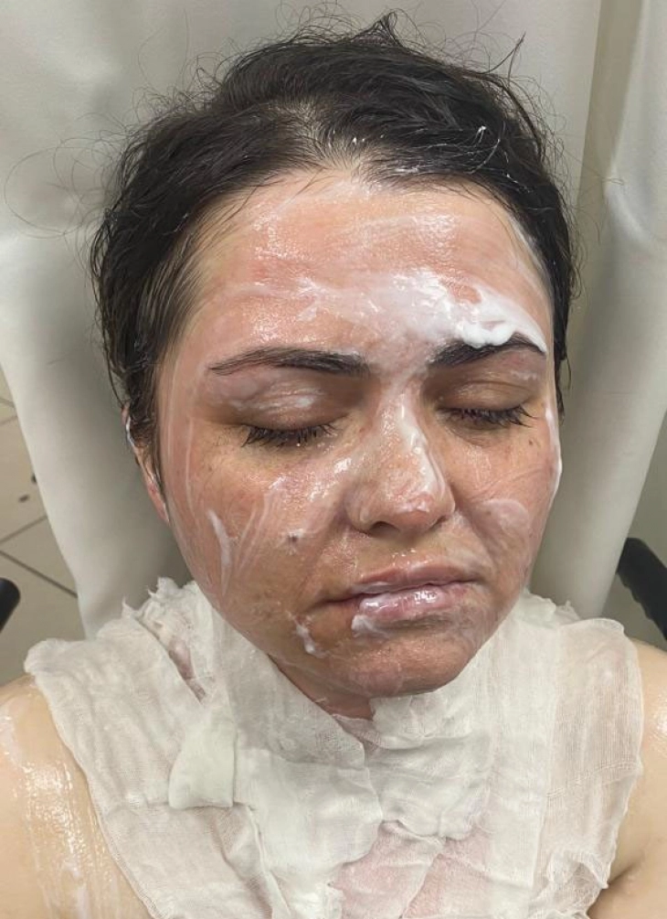 Güzelliğine mi güveniyorsun dedi, yüzüne kimyasal madde fırlattı