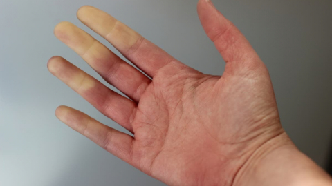Raynaud hastalığına dikkat!