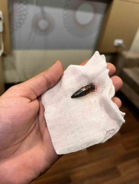 Gazzeli Awad, 1,5 yıldır kafasında taşıdığı mermiden Türk yardımseverlerin desteğiyle kurtuldu