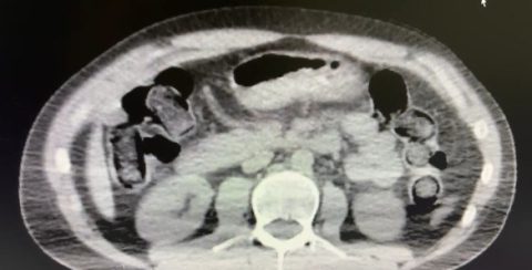 Midelerinde uyuşturucu sevkiyatı yapan 2 torbacı tutuklandı